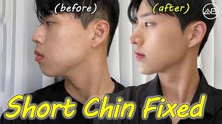  Fixing a Short Chin Changed My Side Profile | AB Plastic Surgery