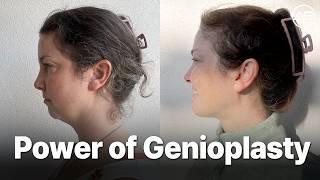 Genioplasty Patient Interview | Her Experience & Results at AB Plastic Surgery | AB Plastic Surgery