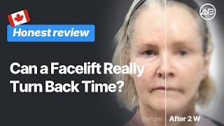  Can a Facelift Really Turn Back Time? ✨ | AB Plastic Surgery