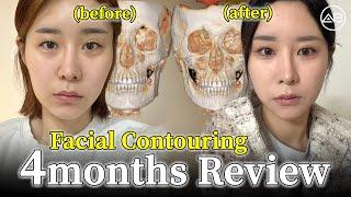Unbelievable Facial Contouring Transformation After 4 Months | AB Plastic Surgery