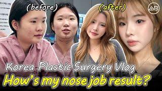 This Nose Job Changed My Face | AB Plastic Surgery