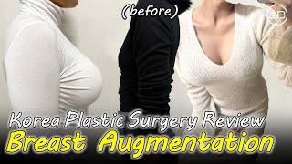 Breast Augmentation in Korea | 1 Month Before & After Review | AB Plastic Surgery