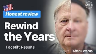 e Didn't Look Different. He Looked Younger. | Facelift & Lower Blepharoplasty | AB Plastic Surgery