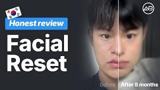 You Won’t Believe This Transformation👀 | Korea Plastic Surgery