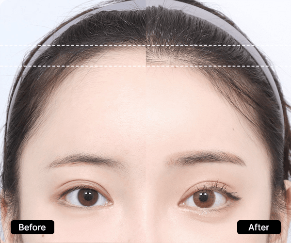 Forehead Reduction | AB Plastic Surgery