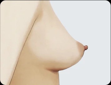 Other Atypical Breast Shapes