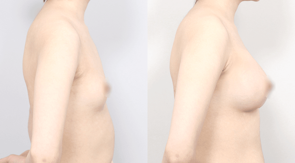 Breast Mento Breast Implants Surgery Slide image