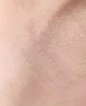 Transaxillary Incision Area after 2 months