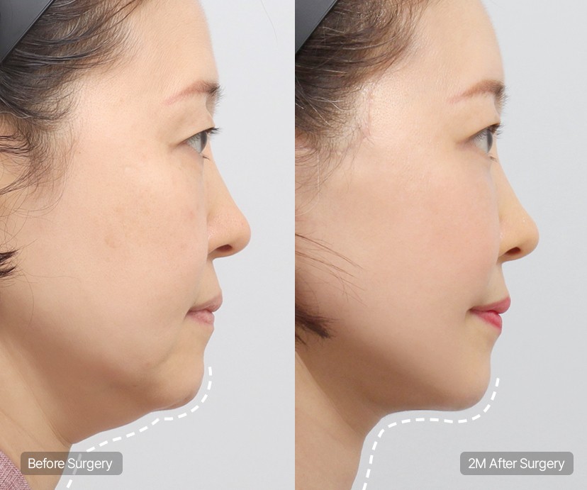 Submentoplasty double chin muscle tightening procedure