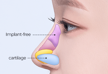 Prominent hump nose surgery — step 2