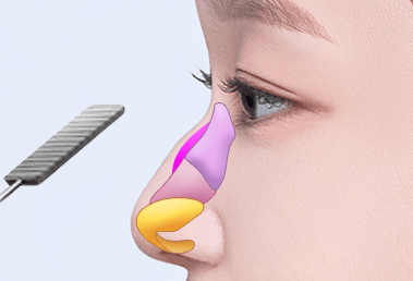 Low hump nose surgery — step 1