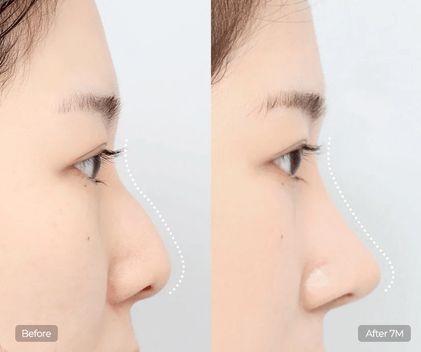 Hump Nose Rhinoplasty