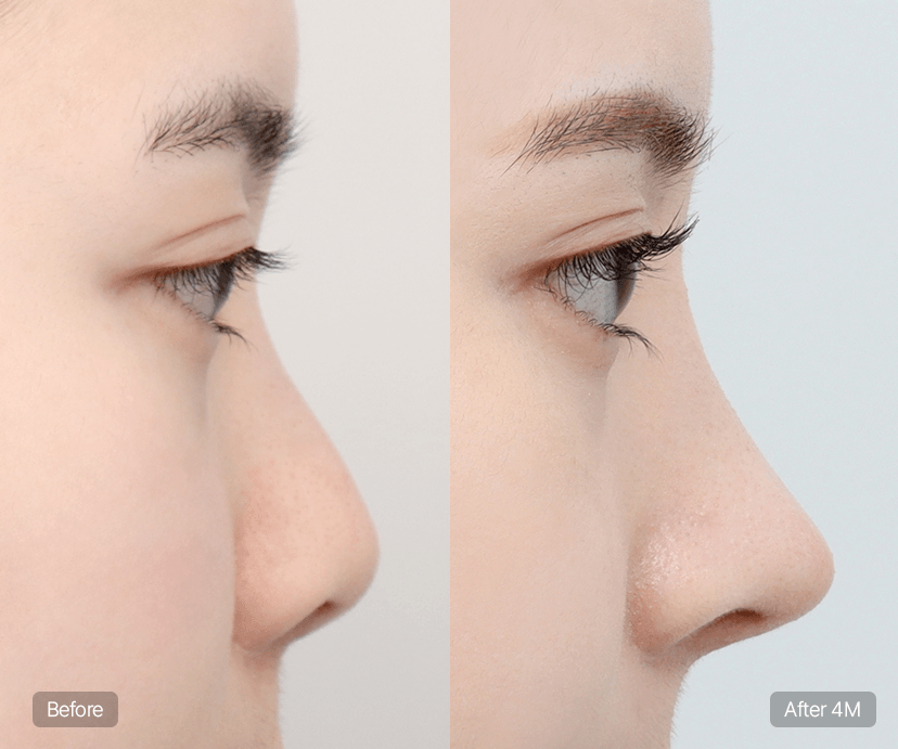 Short Nose Rhinoplasty