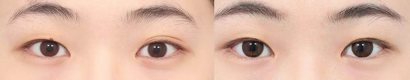 ABC point before and after case 1