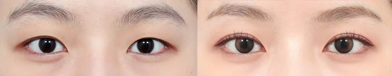 ABC point before and after case 2
