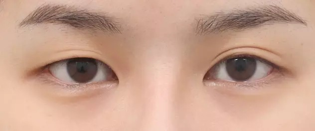 Before translucent adhesion eye surgery