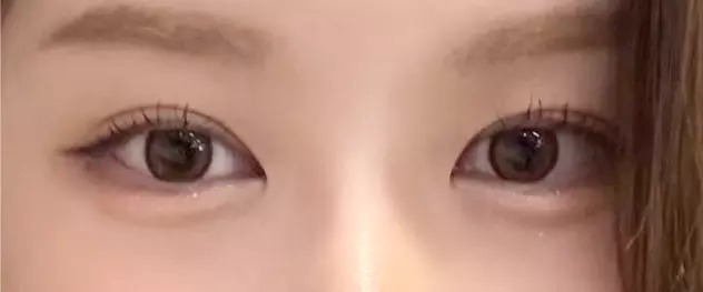 11 months after translucent adhesion eye surgery