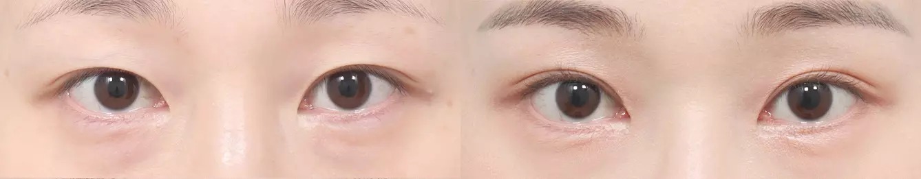 Eye line before and after case 2