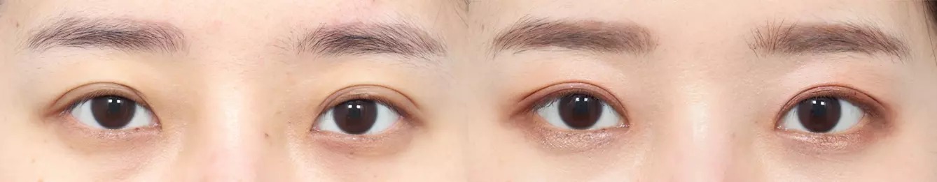 Eye line before and after case 3
