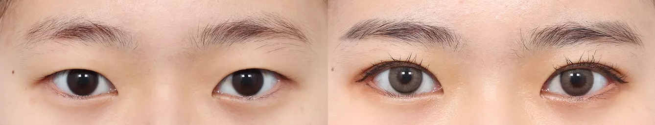 Double eyelid before and after case 3