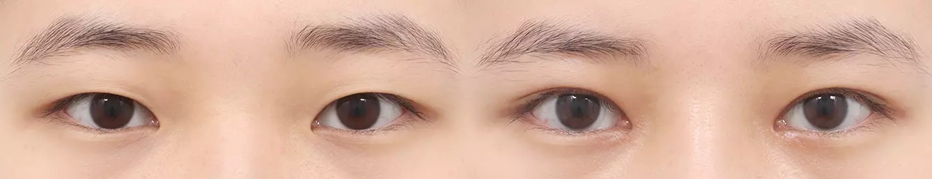 Double eyelid before and after case 5