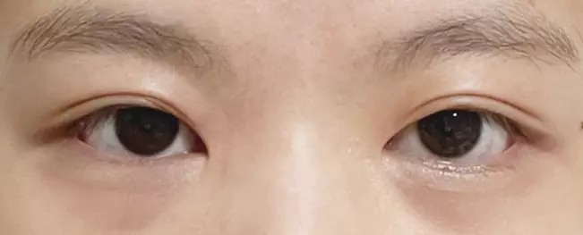Long lasting before after case 3