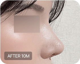 Before and after 2-3