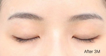 Eye Revision Blepharoplasty Scar Progression image
