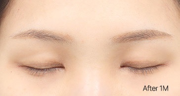 Eye Revision Blepharoplasty Scar Progression image