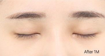 Eye Revision Blepharoplasty Scar Progression image