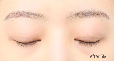 Eye Revision Blepharoplasty Scar Progression image