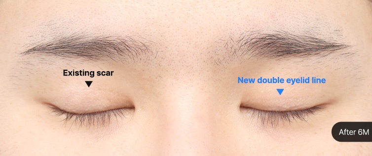 Eye Revision Blepharoplasty Scar Progression image