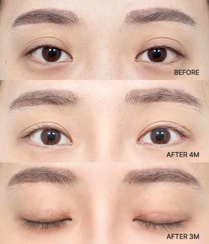 Eye Revision Blepharoplasty Solution Solution Card image