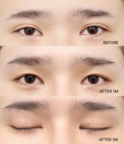 Eye Revision Blepharoplasty Solution Solution Card image