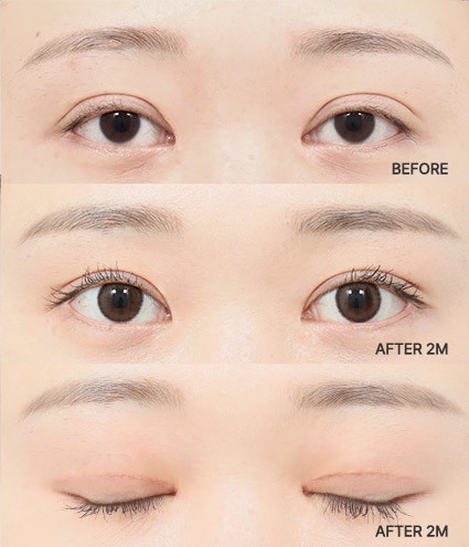 Eye Revision Blepharoplasty Solution Solution Card image