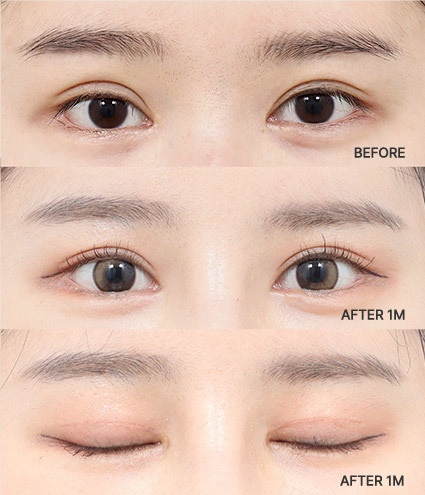 Eye Revision Blepharoplasty Solution Solution Card image