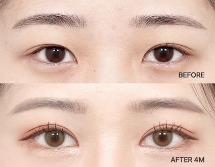 Eye Revision Blepharoplasty Solution Solution Card image