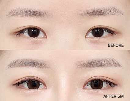 Eye Revision Blepharoplasty Solution Solution Card image