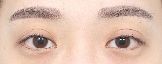 Eye Revision Blepharoplasty Case Swiper image