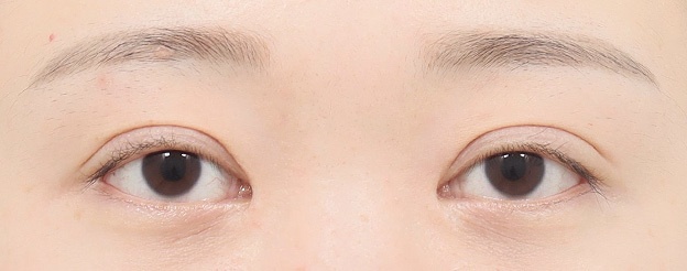 Eye Revision Blepharoplasty Case Swiper image