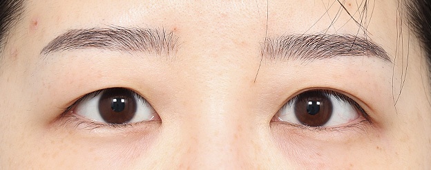 Eye Revision Blepharoplasty Case Swiper image