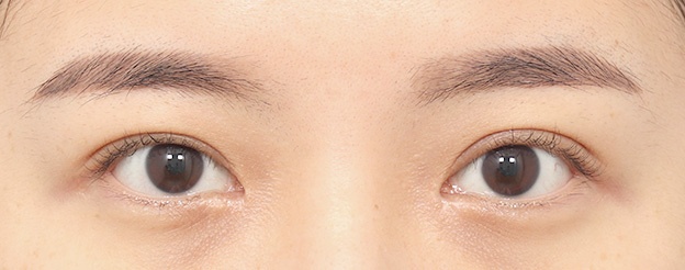 Eye Revision Blepharoplasty Case Swiper image