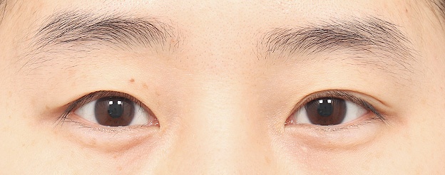 Eye Revision Blepharoplasty Case Swiper image