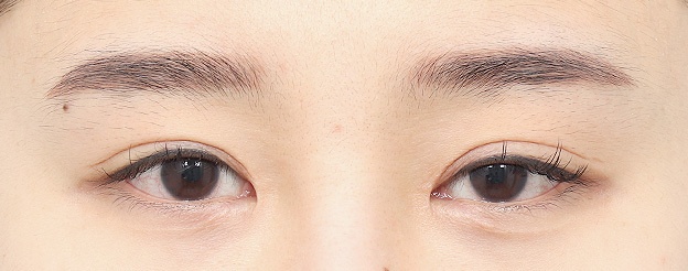 Eye Revision Blepharoplasty Case Swiper image