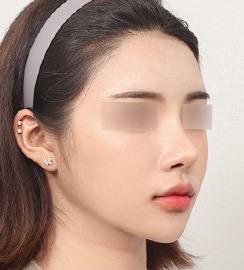 3 months after surgery