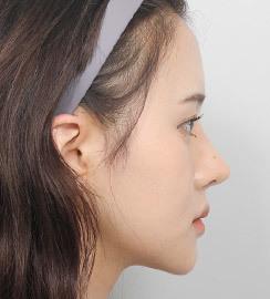 3 months after surgery