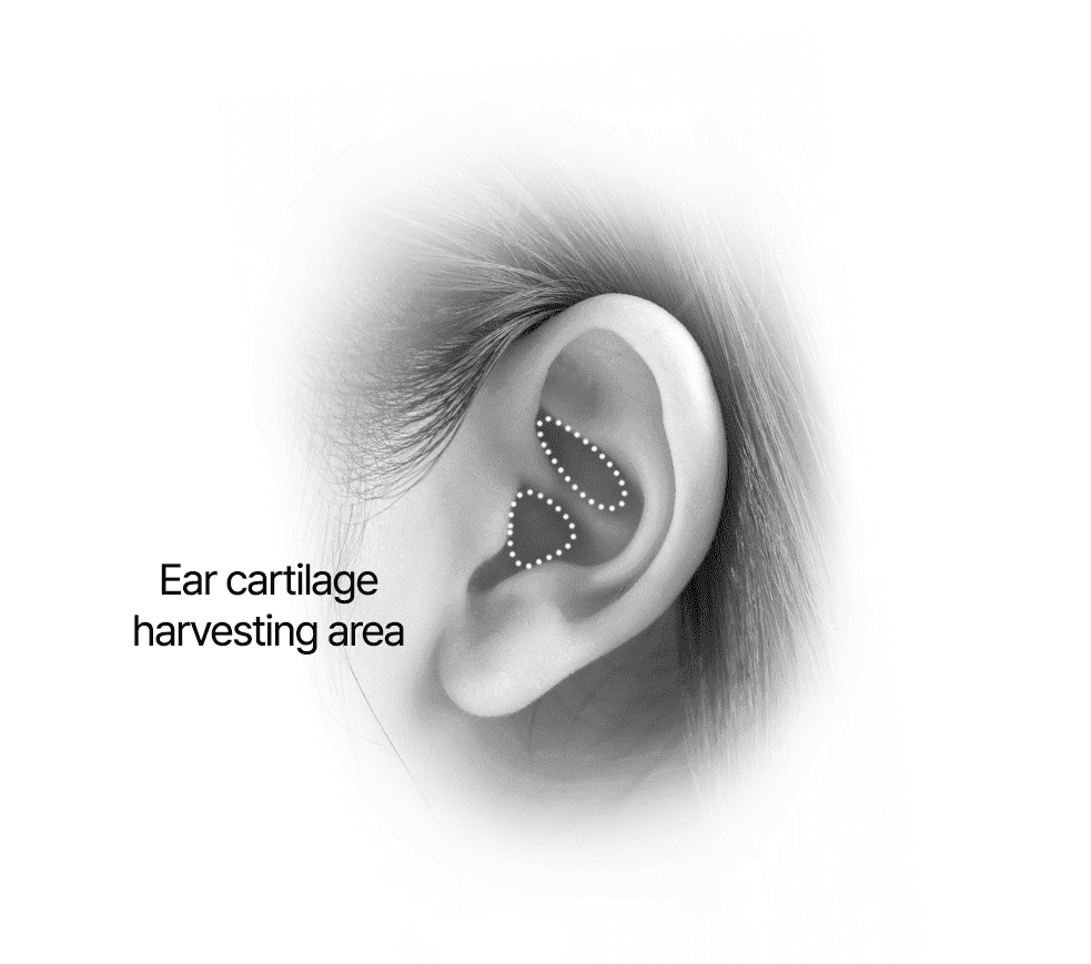 Harvesting Ear Cartilage