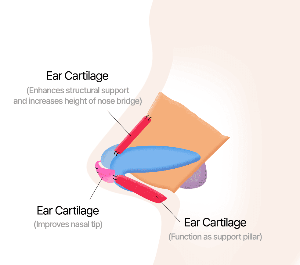 Nasal Bridge, Columella and Tip Correction Using Ear Cartilage