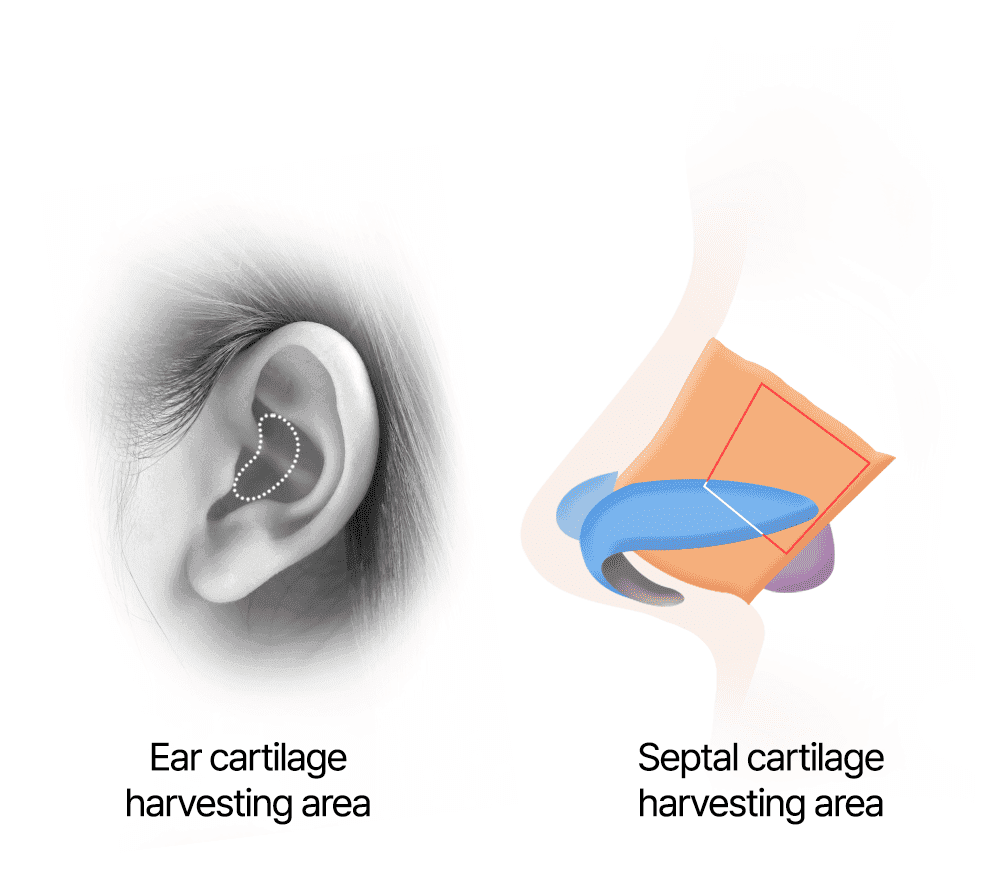 Harvesting ear and septal cartilages