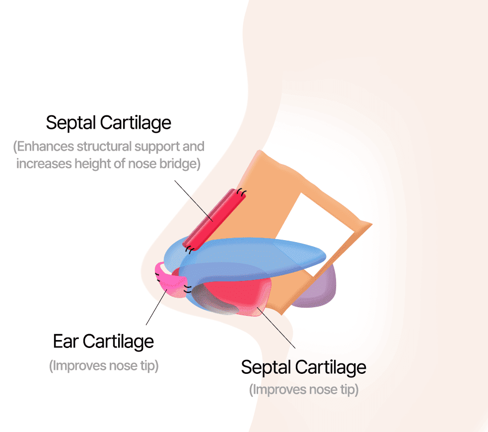 Correction utilizing ear and septal cartilages